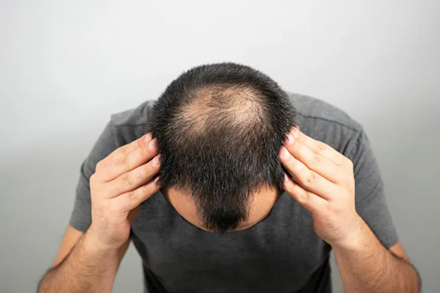 Облысение: ресвератрол остановит выпадение волос и поможет их отрастить быстрее - где он содержится?