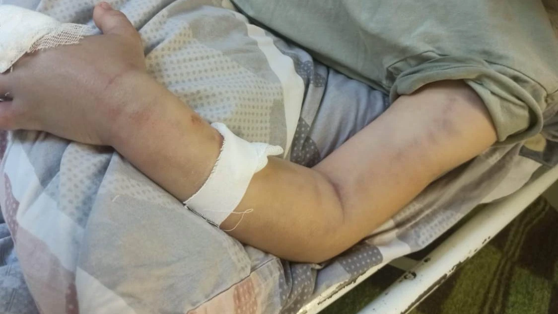 У Саши распухла рука после укуса гадюки. Фото: Предоставлено мамой мальчика