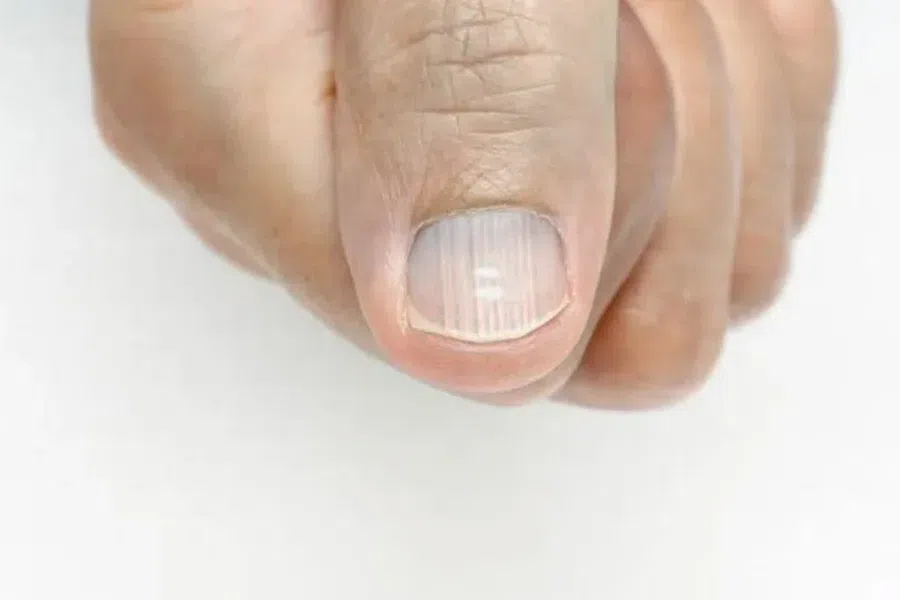 Симптомы Омикрона на коже, губах и ногтях: когда необходимо срочное лечение