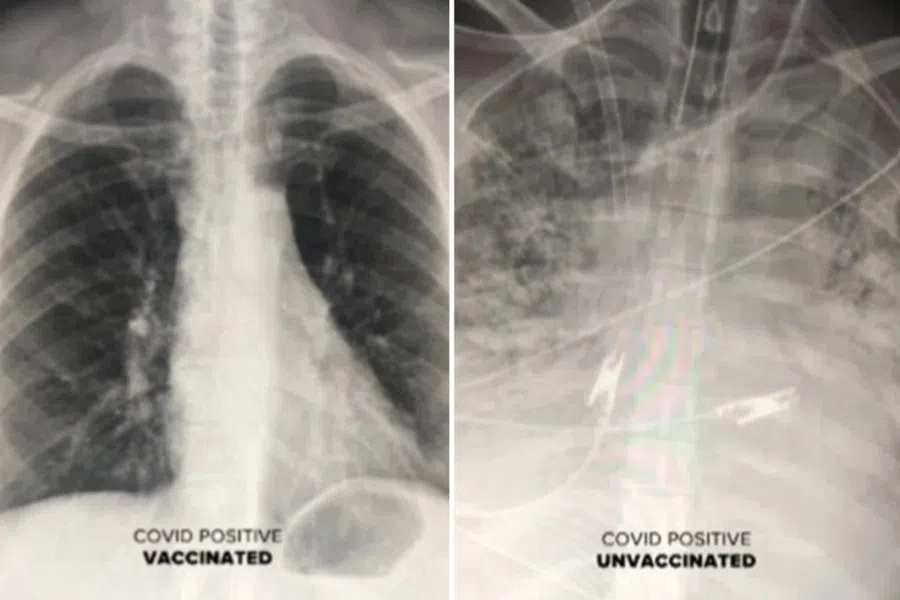 Рентгеновские снимки лёгких вакцинированных и не вакцинированных людей, заболевших коронавирусом