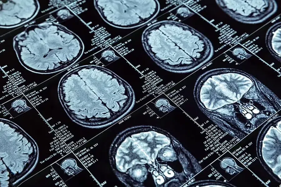 «Ковидный мозг» реален: заболевание уменьшает области мозга и ухудшает когнитивные функции