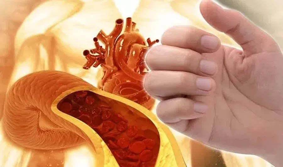 Посмотрите на ваши ногти: высокий холестерин и заболевания сердца могут изменить вид ногтей