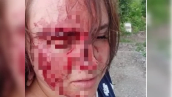 В Новосибирске местный житель избил соседку камнями из-за неправильно припаркованной машины - молодой девушке зашивали лицо