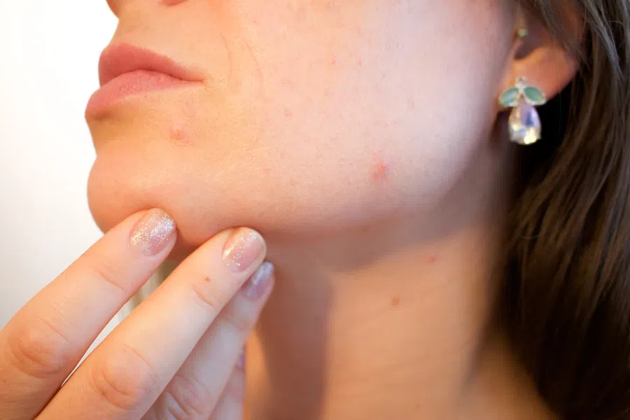 Врачи заявили, что при штамме коронавируса омикрон на коже появляется сыпь