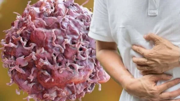 Неожиданные симптомы рака поджелудочной железы могут проявляться в расстройства желудка: горечь во рту, изжога, боль могут быть сигналами о растущем раке 