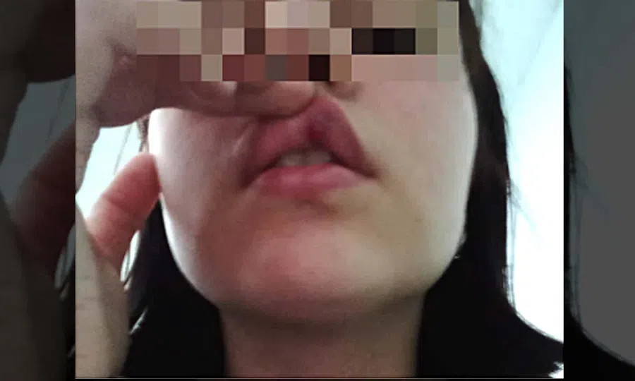 Сотрудница ПДН изуродовала губу 14-летней девочке из-за разговора с отцом в отделе полиции Бердска, заявила мать и показала видео