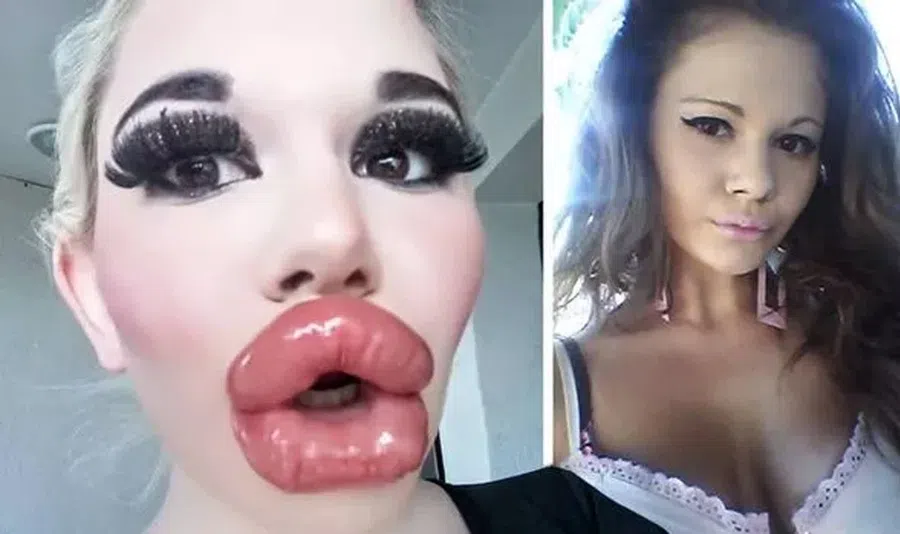 Самые большие губы в мире: женщина сделала 26 инъекций, чтобы выглядеть как кукла Братц