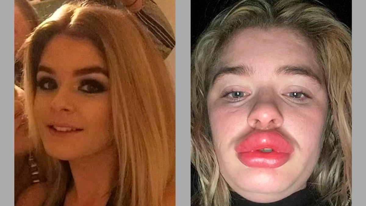 В Британии 22-летняя мать двоих детей увеличила губы и стала похожа на надутую куклу с рыбьим ртом. Губы чуть не лопнули – фото