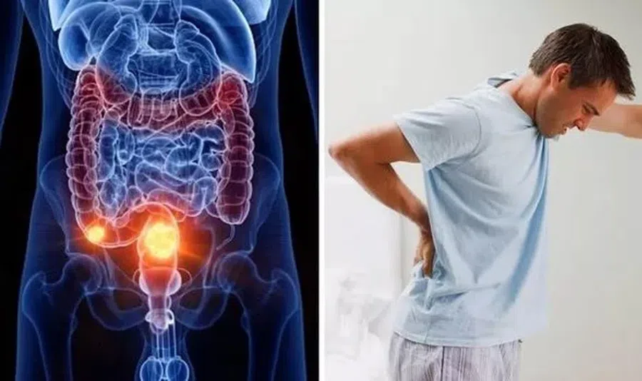 Симптомы рака кишечника: редкий, но болезненный знак в спине может сигнализировать о раке