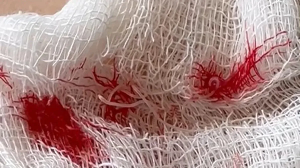 В Волгограде из груди мужчины вытащили червя-паразита длиной 15 см - фото