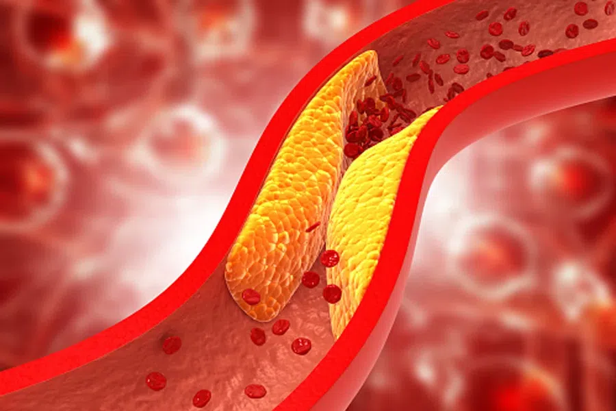 Инсульт и инфаркт могут развиться не только от холестерина: кардиологи обнаружили, что виноват также высокий показатель кальция в коронарных артериях