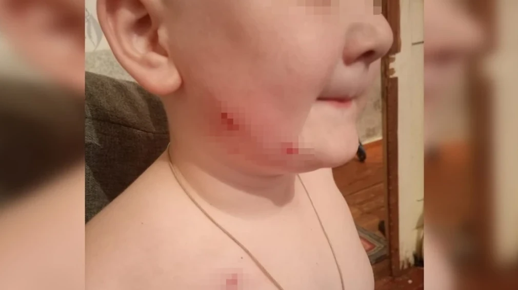Под Новосибирском бродячая собака укусила в лицо 5-летнего мальчика