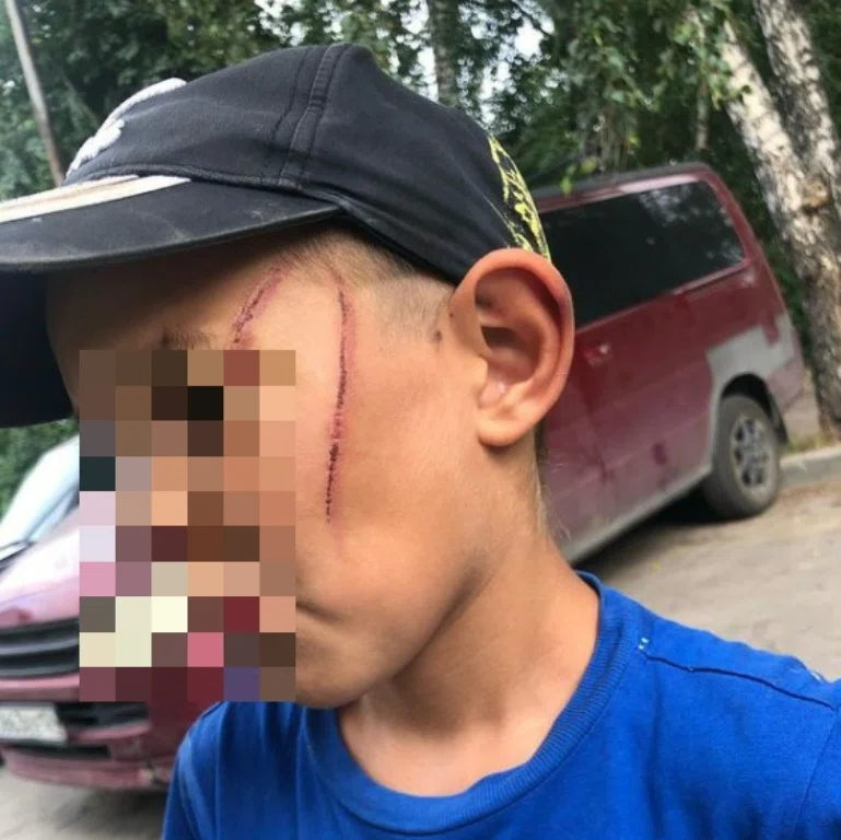 "Это меня дядя Олег": Проводом от чайника жестоко избили 7-летнего Тимура в Новосибирске. Смотрите фото